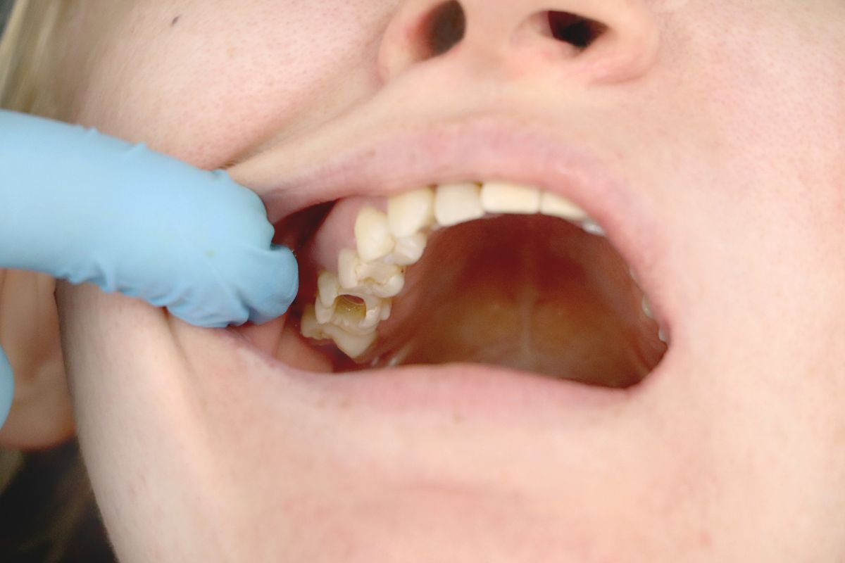 How Long Can A Cavity Go Untreated